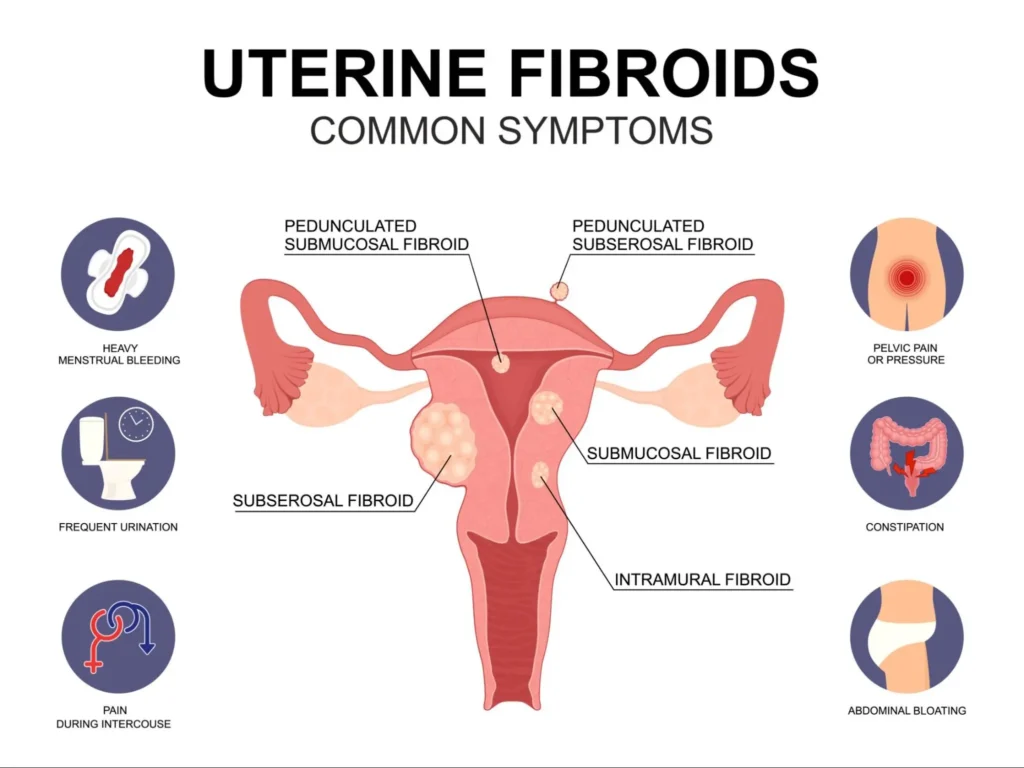 Uterus Fibroids