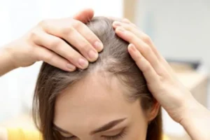 pcos hair fall in women