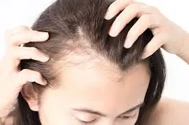 pcod hair fall in women