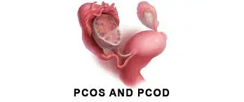 PCOD और PCOS