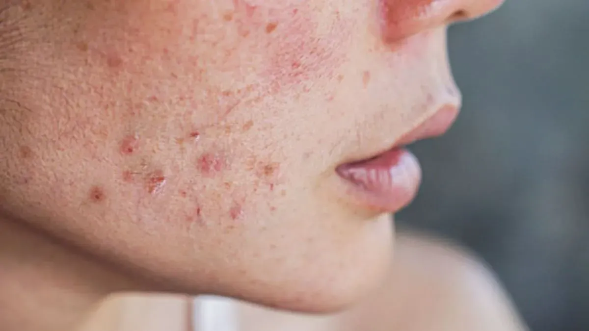 PCOD में चेहरे के मुंहासे